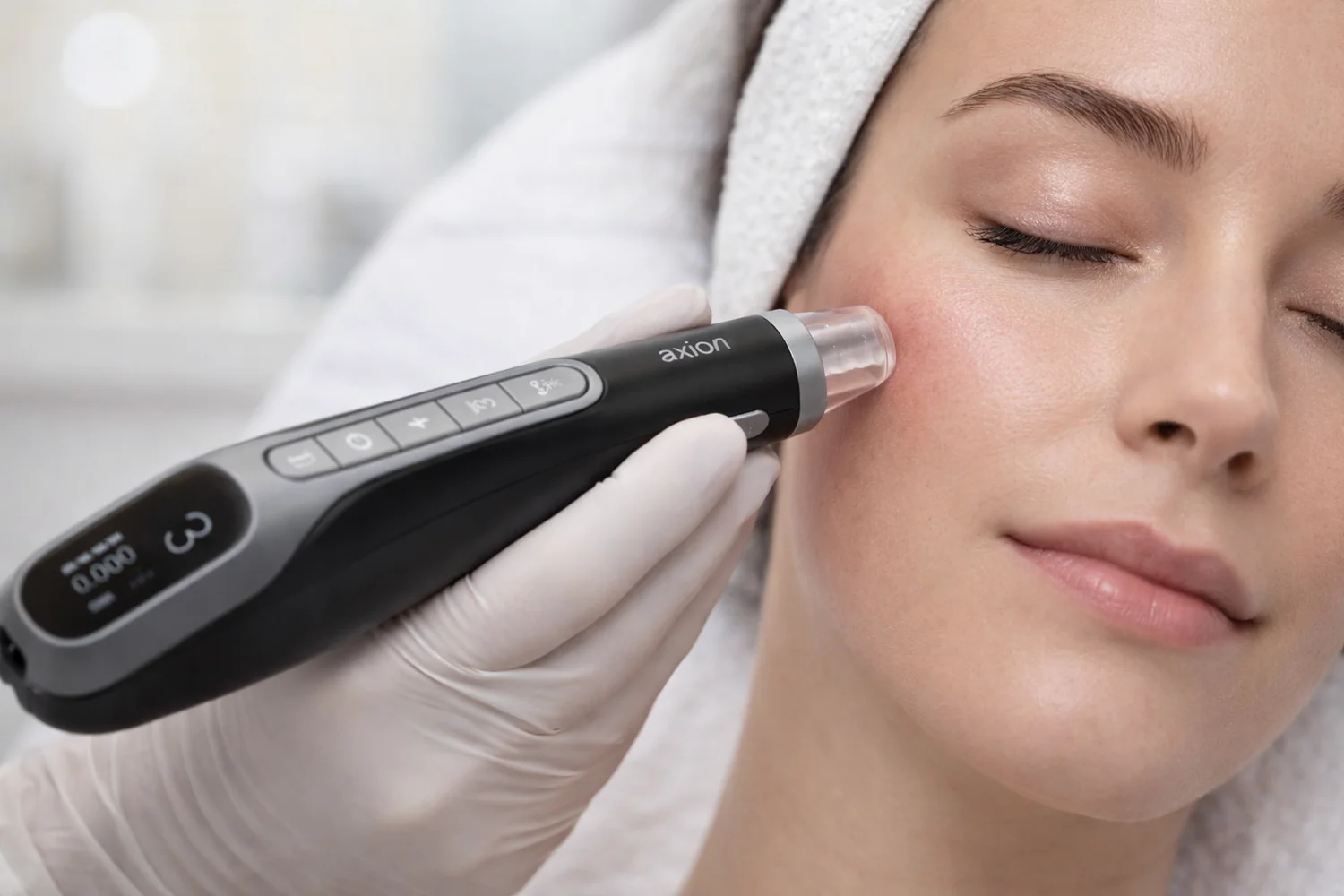 Mano con guante aplicando el dispositivo Dermapen AXION sobre la mejilla de una paciente